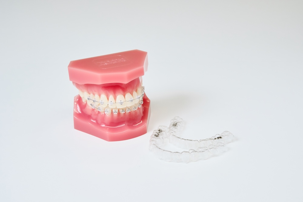 クローバー歯科の初回無料矯正相談