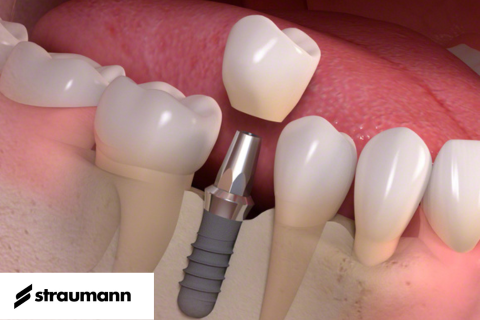 ストローマン画像