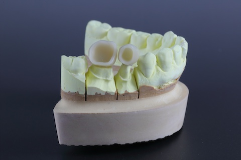 セラミック歯の模型
