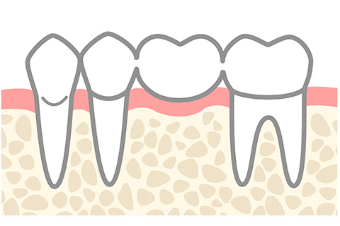 ブリッジ治療の仕組みを説明する図解