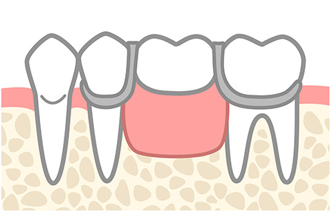 部分入れ歯と総入れ歯の種類