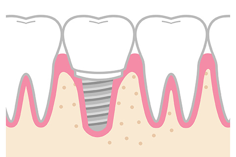 インプラント治療の3つの構造（インプラント体・アバットメント・上部構造）