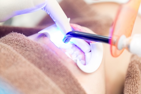 何を食べたらいい？ホワイトニング中の食事と食事制限のポイント