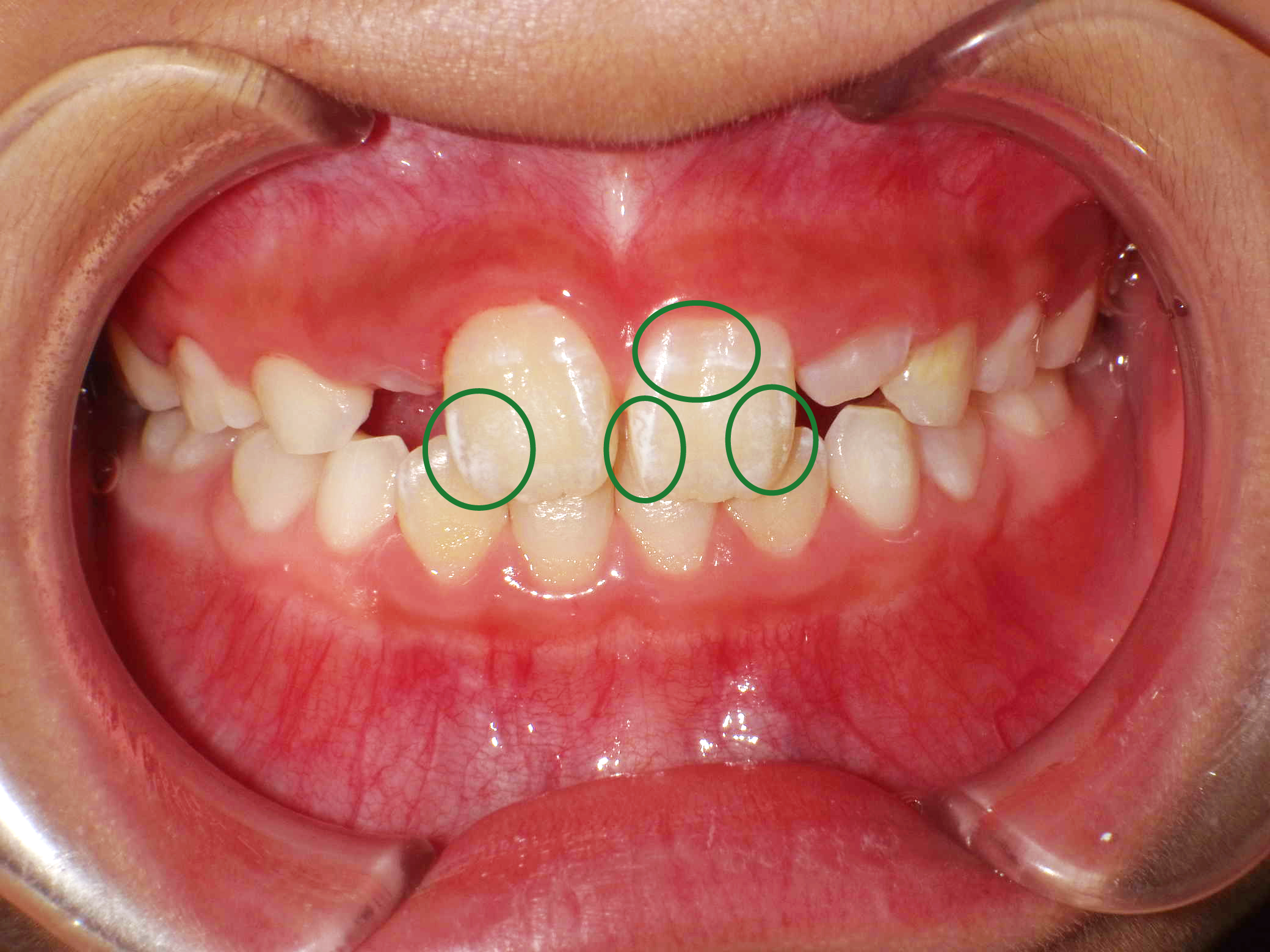 子ども虫歯画像