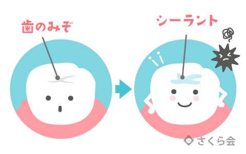 シーラント治療の説明画像