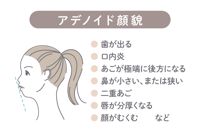 アデノイド顔貌は、出っ歯や口内炎、あごが極端に後方になる、鼻が小さい、二重あご、唇が分厚くなる、顔がむくむなどの影響が出ることがあります。