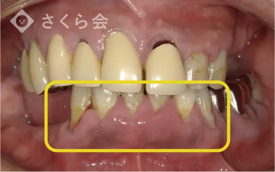 治療前の歯の写真