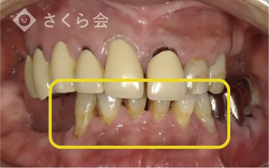 治療後の歯の写真