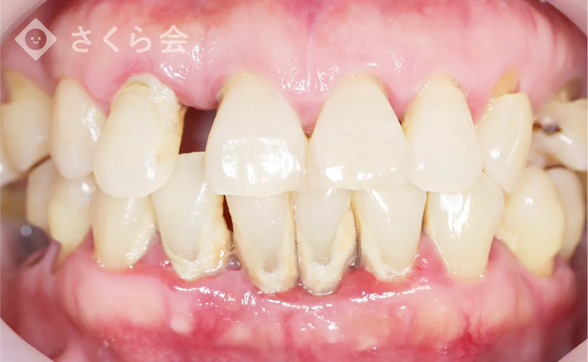 歯周病による歯茎の腫れと炎症の症例写真