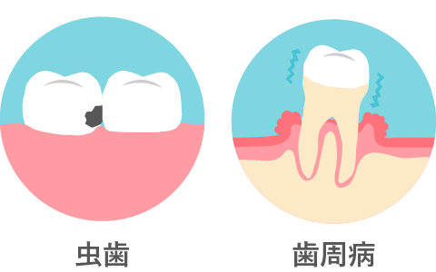 左側に虫歯になった歯のイラストがあり、右側に歯周病になったイラストがある。