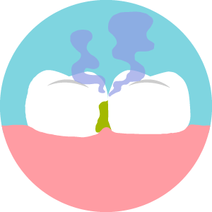 はの間に汚れ、歯石がたまり臭いを発しているイラスト。