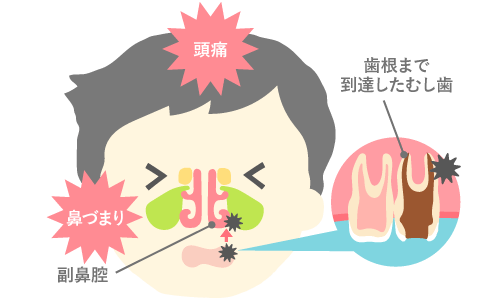 親知らずが感染源になっている副鼻腔炎の説明をするイラスト。