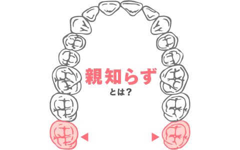 片顎の歯並びを上から模写した画像。親知らずの場所を色をつけて示している。