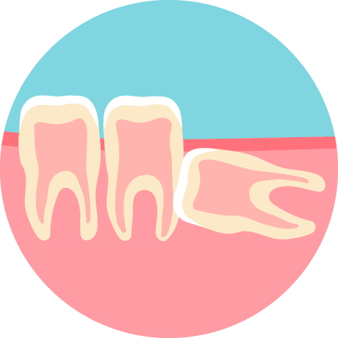 抜かないといけない親知らず。完全に横向きになってしまって、奥歯を前方に押している。